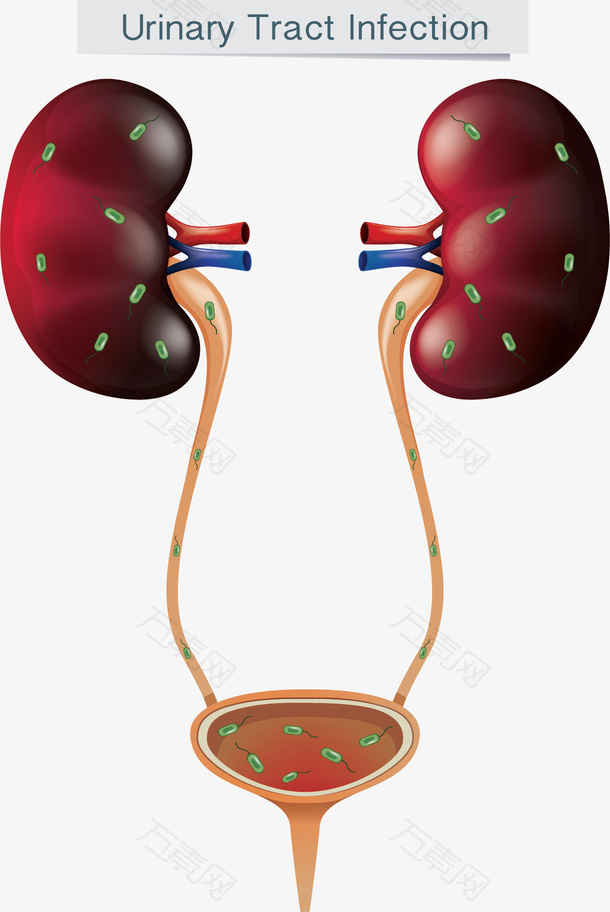 医学尿路感染示意图